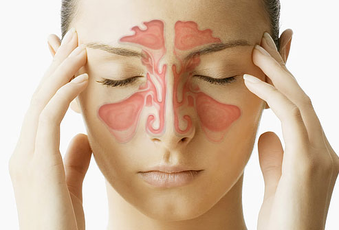 Inflammation des sinus (sinusite)