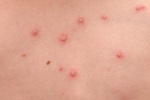 symptômes varicelle